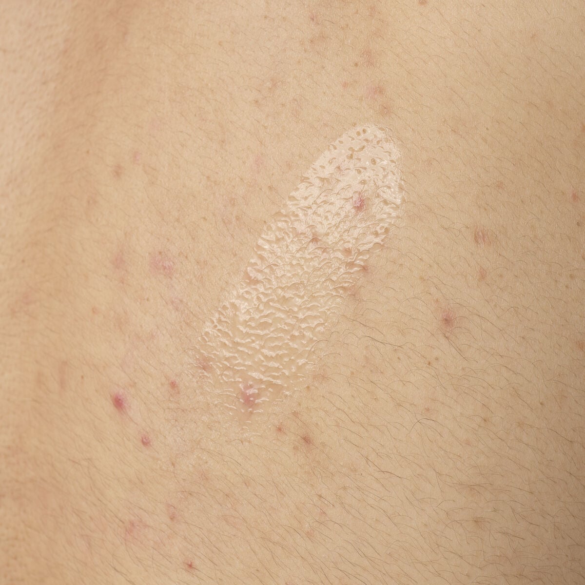 salicylic-acid-0-5-body-serum-h9 ORD-salicylic-acid-05-body-240ml-application.jpg