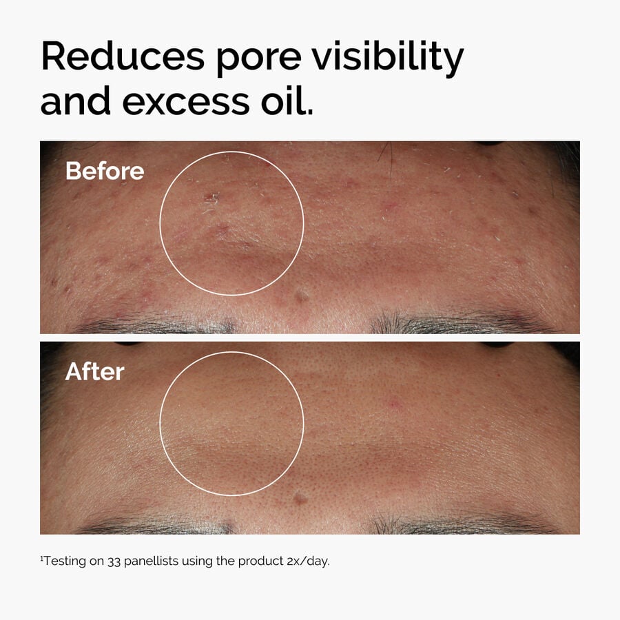 niacinamide-10-zinc-1-z8 ord-niacinamide-zinc-blemish-serum-before-after-pores.jpg