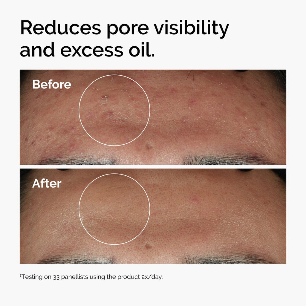 niacinamide-10-zinc-1-z8 ord-niacinamide-zinc-blemish-serum-before-after-pores.jpg