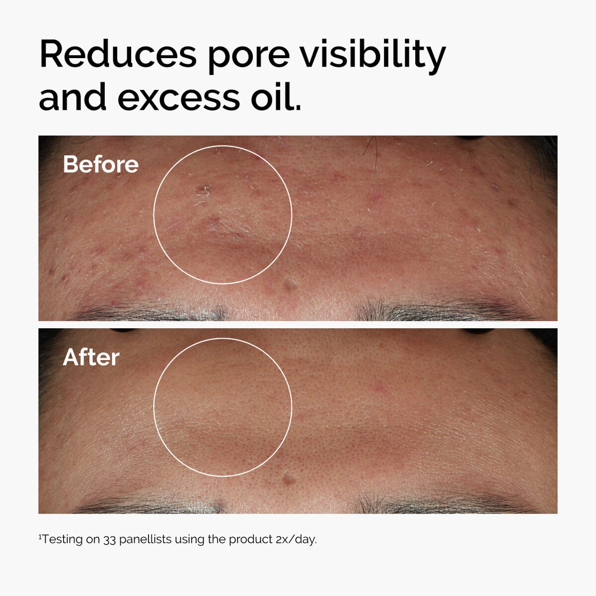 niacinamide-10-zinc-1-z8 ord-niacinamide-zinc-blemish-serum-before-after-pores.jpg