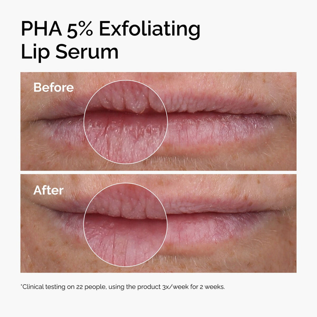pha-5-exfoliating-lip-serum-z2 ord-pha-5pct-lip-exfoliating-serum-before-after.jpg
