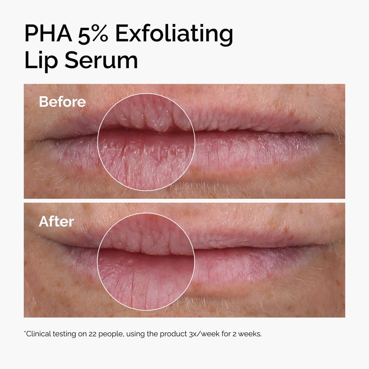 pha-5-exfoliating-lip-serum-z2 ord-pha-5pct-lip-exfoliating-serum-before-after.jpg