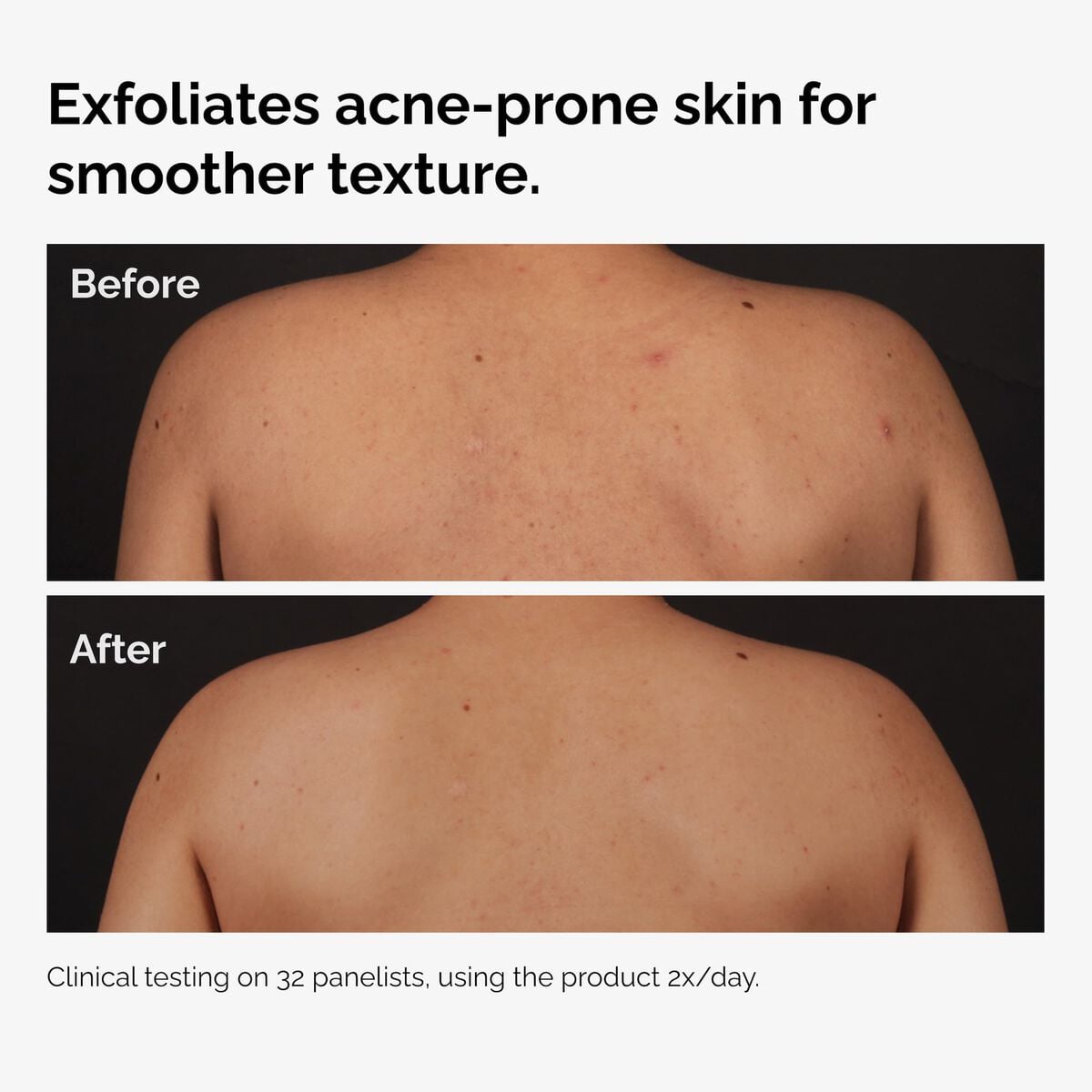 salicylic-acid-0-5-body-serum-h9 ord-salicylic-acid-body-serum-before-after-graphic-NA.jpg