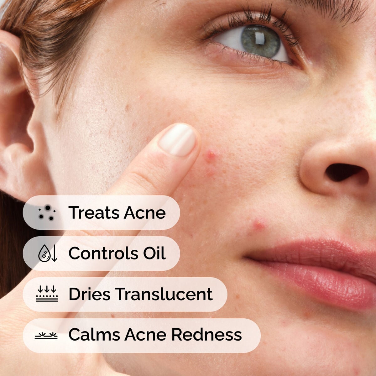 sulfur-10-powder-to-cream-concentrate-g4 ord-sulfur-10pct-powder-to-cream-concentrate-model-application-with-benefits-acne.jpg