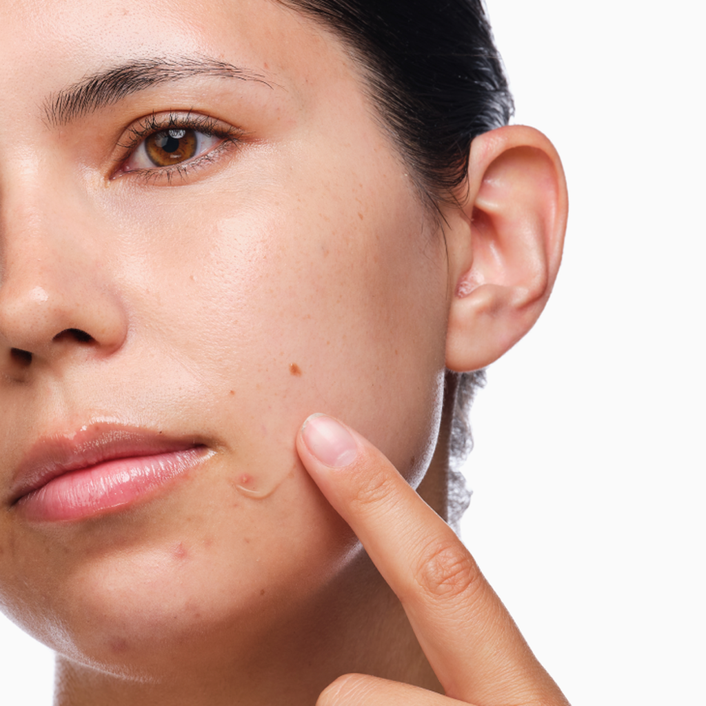 the-acne-set-f0 rdn-the-acne-set-application.png